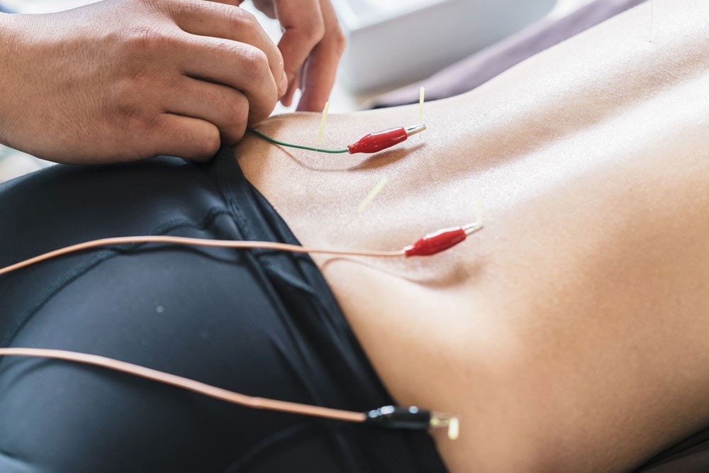 What is Electro-Dry Needling and how can it help with chronic pain and  injury treatment?