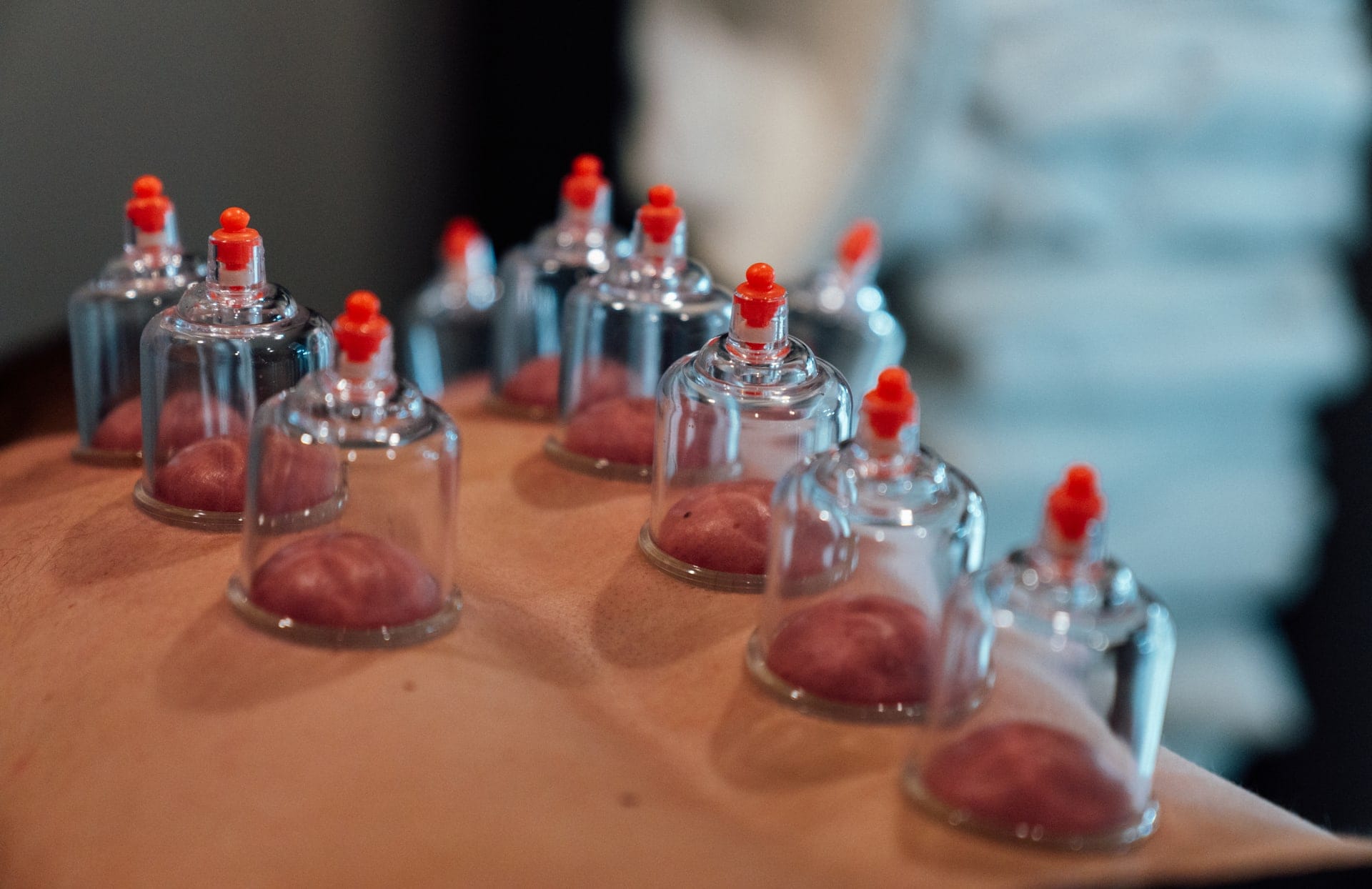 The Benefits of Cupping Depth Training & Physiotherapy